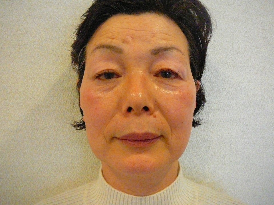 顔歪み矯正コース　ビフォーアフター写真