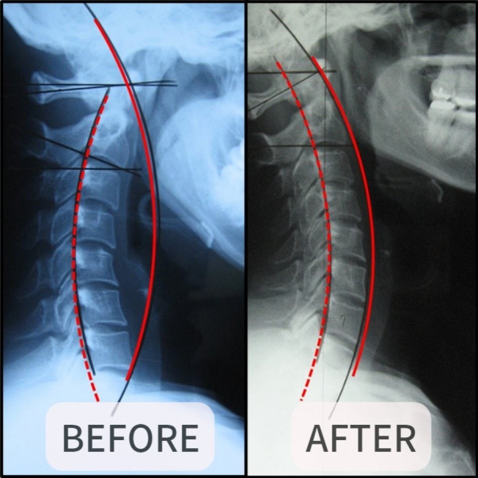 大阪市福島区のストレートネック、骨盤矯正専門のカイロプラクティック整体ヘンミ　首の痛み、肩こり、手のシビレ、腰痛、坐骨神経痛、頭痛、めまい、頚椎症、自律神経失調症でお悩みの方は当院にお任せください。