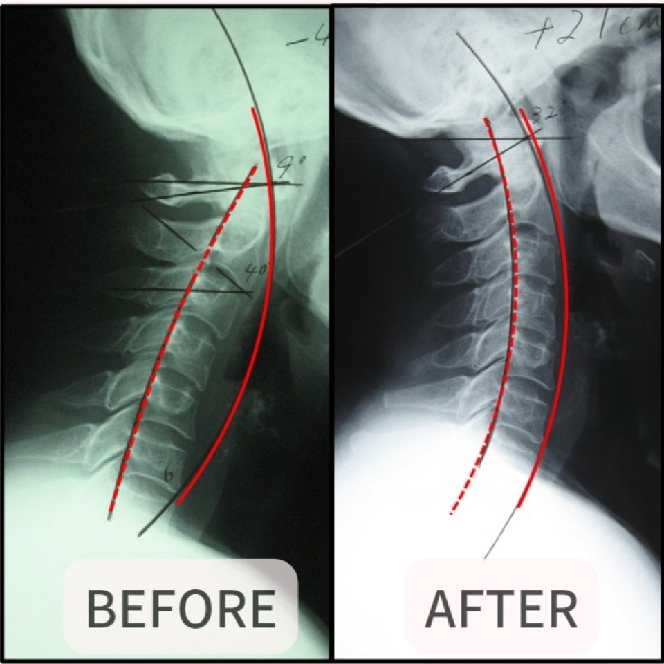 大阪市福島区のストレートネック、骨盤矯正専門のカイロプラクティック整体ヘンミ　首の痛み、肩こり、手のシビレ、腰痛、坐骨神経痛、頭痛、めまい、頚椎症、自律神経失調症でお悩みの方は当院にお任せください。