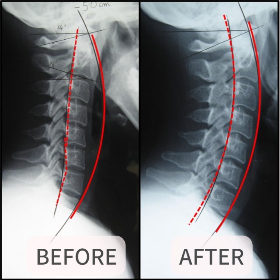 大阪市福島区のストレートネック、骨盤矯正専門のカイロプラクティック整体ヘンミ　首の痛み、肩こり、手のシビレ、腰痛、坐骨神経痛、頭痛、めまい、頚椎症、自律神経失調症でお悩みの方は当院にお任せください。
