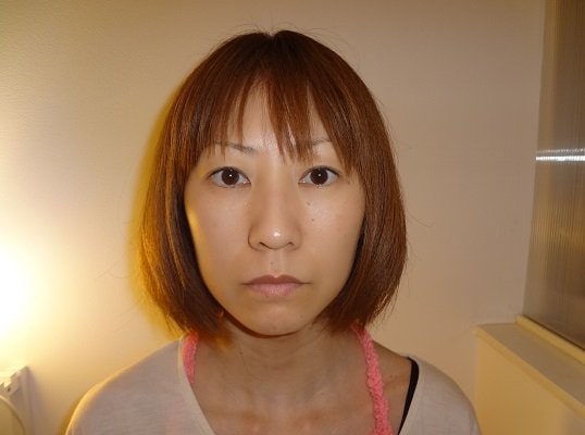 小顔矯正before