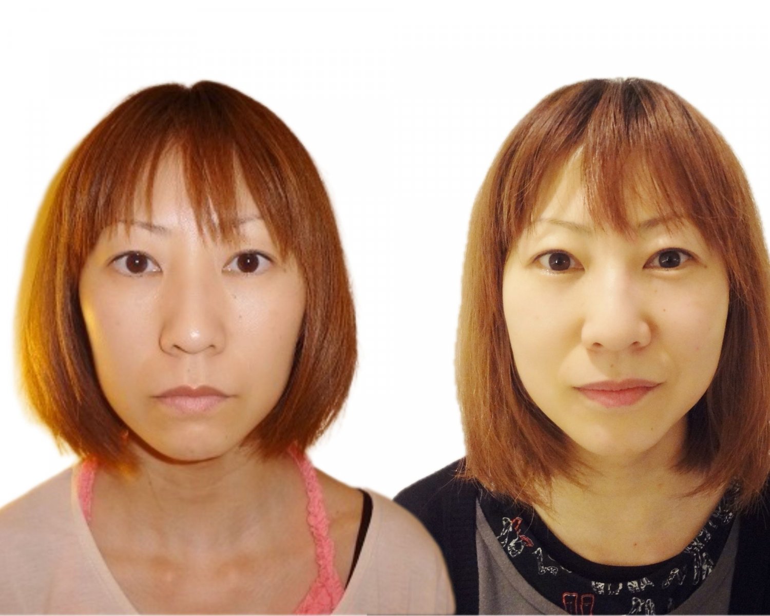 小顔before＆after