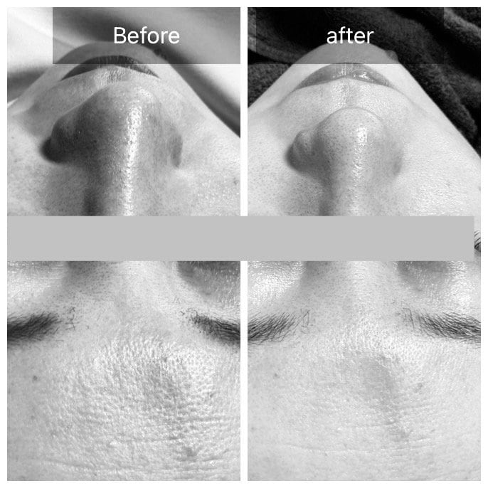 ホワイトスノーピール1回施術後