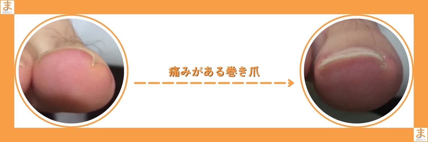 横浜巻き爪センター｜横浜で「切らない」「痛くない」巻き爪矯正