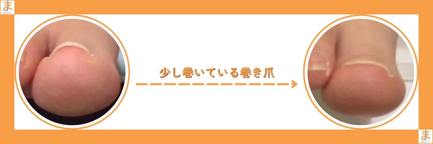 横浜巻き爪センター｜横浜で「切らない」「痛くない」巻き爪矯正