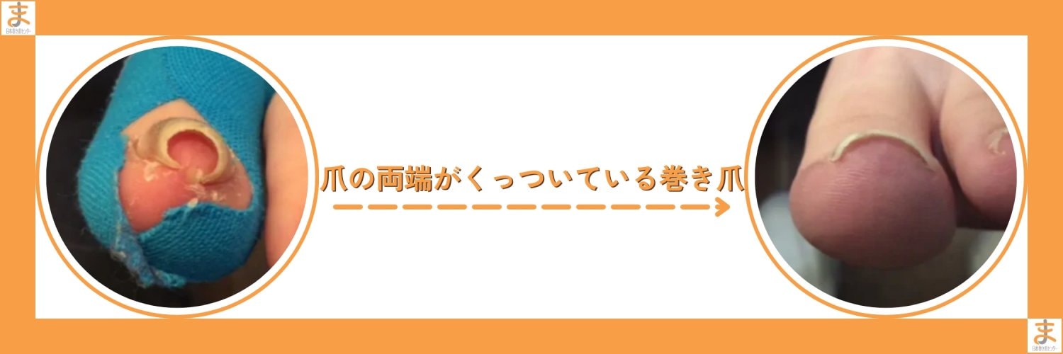 横浜巻き爪センター｜横浜で「切らない」「痛くない」巻き爪矯正