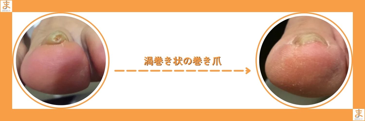 横浜巻き爪センター｜横浜で「切らない」「痛くない」巻き爪矯正