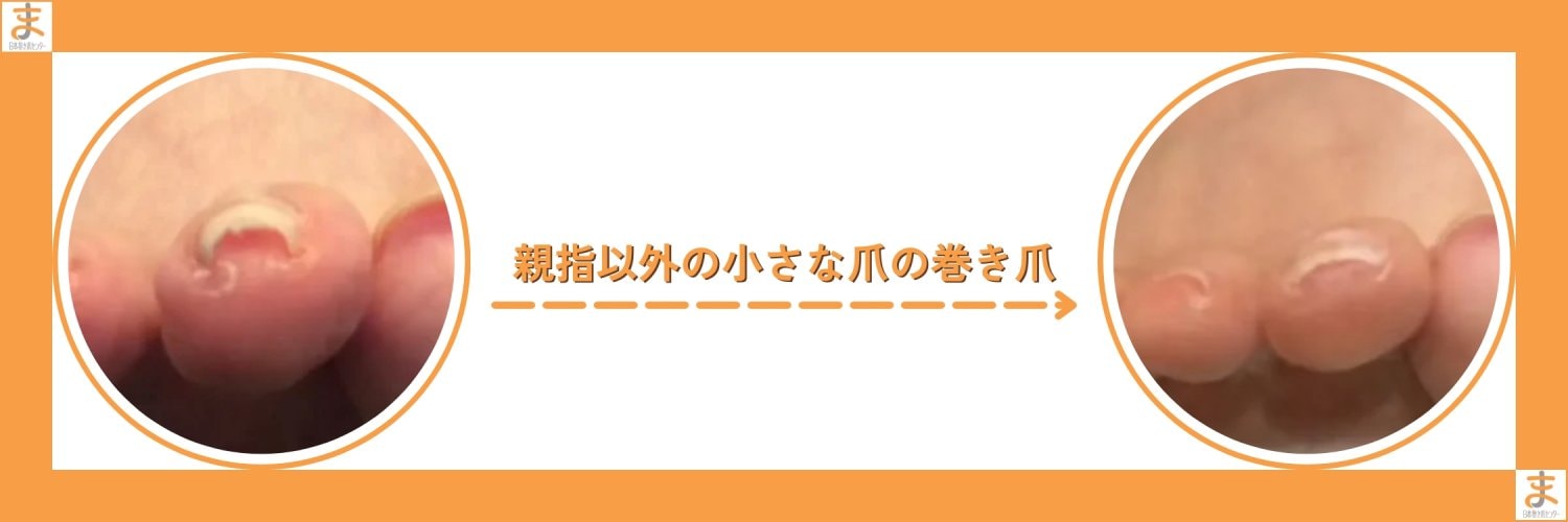 横浜巻き爪センター｜横浜で「切らない」「痛くない」巻き爪矯正