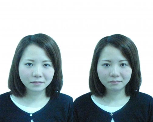 顔歪み矯正before＆after