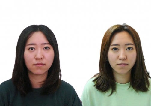 顔歪み矯正でここまで変わる