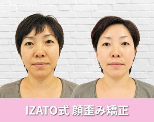 顔歪み矯正before &amp;after