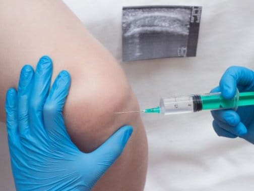 膝の痛みにヒアルロン酸注射は効果ある？注射のみで治るの？