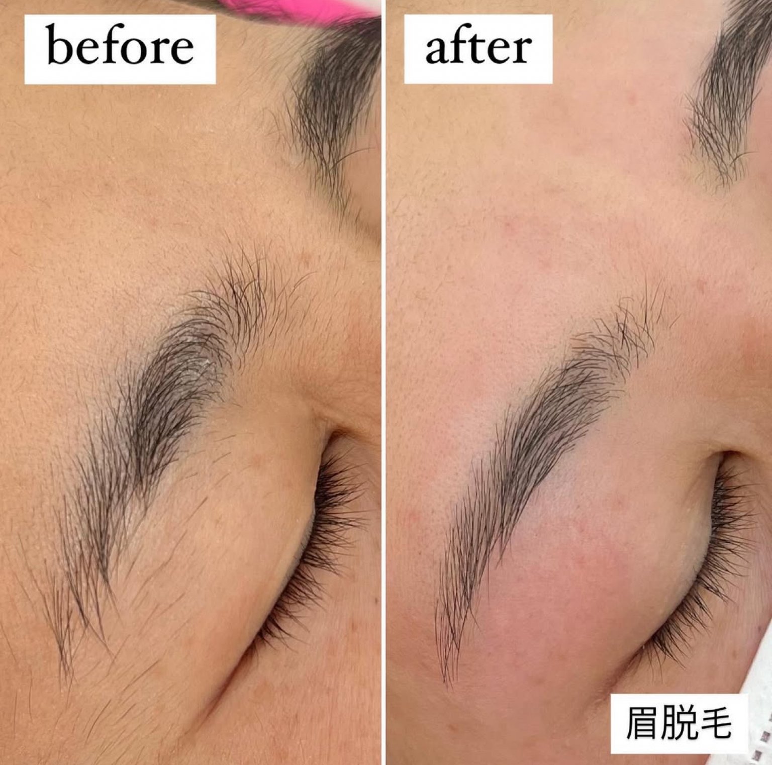 【初回セット価格】眉脱毛×眼輪筋トレーニング 15分