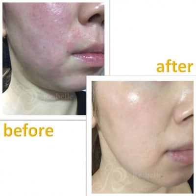 リベルハーブピーリング セット ハーブピーリング リベルハーブピーリング セット ハーブピーリング ♡専用 リベルハーブ