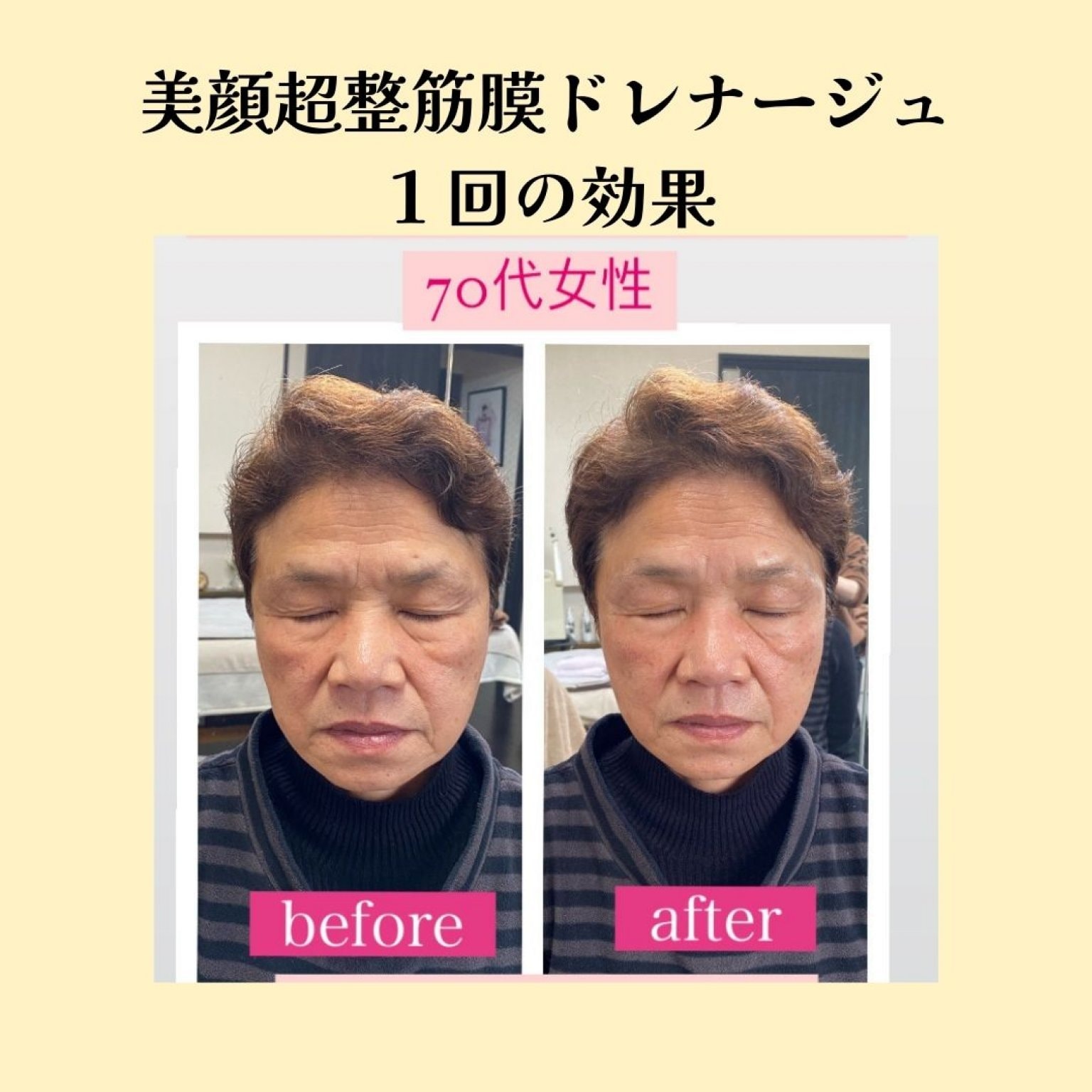 小顔骨格美顔超整セラピー筋膜ドレナージュ肌質改善トリートメントつき(6回数券）