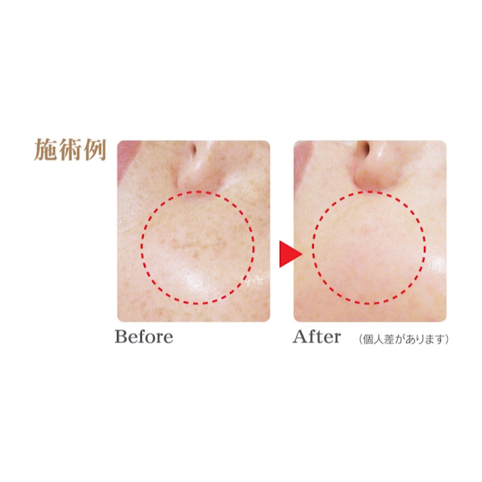 【初回限定】シミケアコース