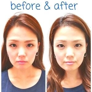 美容鍼Before & After