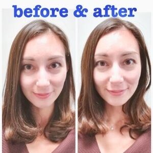 美容鍼Before & After