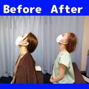 首の可動域改善例